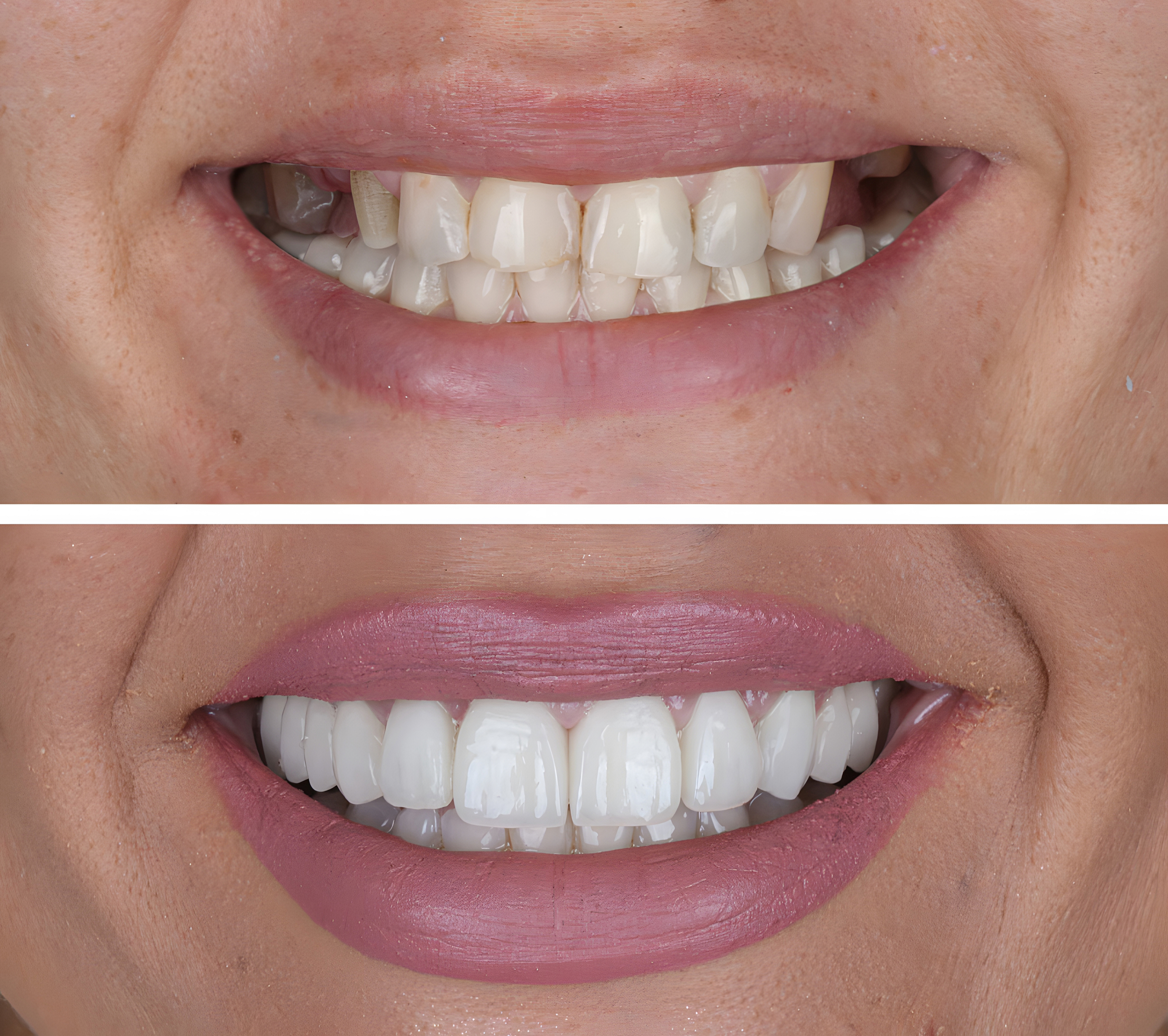 Before and after dental smile transformation showing dramatic improvement in teeth appearance